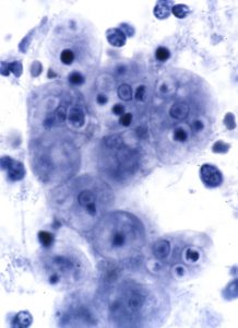 Entamoeba gingivalis