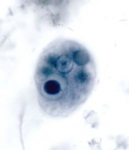 Entamoeba gingivalis