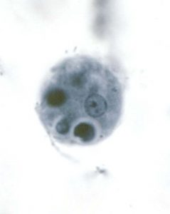 Entamoeba gingivalis