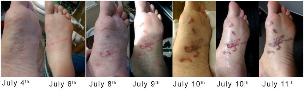 progression of hookworm infection